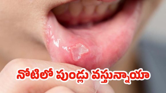 Mouth Ulcers: నోటిలో పుండ్ల సమస్యలకు చెక్.. ఇవి వాడితే క్షణాల్లోనే ప్రాబ్లమ్ సాల్వ్