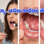 Mouth Ulcer: నోటి పుండ్లు మహిళల్లోనే ఎందుకు ఎక్కువగా వస్తాయి? హార్మోన్లు, ఒత్తిడి, పోషకాహార లోపమే కారణమా?