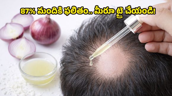 Onion Juice for Hair Regrowth: బట్టతలపై జుట్టు మొలిపించే ఉల్లిపాయ రసం.. ఇంతకీ సైన్స్ ఏం చెబుతోందంటే?