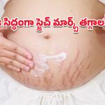 Stretch Marks: స్ట్రెచ్ మార్క్స్‌ను మాయం చేసే మోస్ట్ పవర్‌ఫుల్ టిప్స్.. ఫలితం చూసి మీరే ఆశ్చర్యపోతారు!