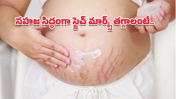Stretch Marks: స్ట్రెచ్ మార్క్స్‌ను మాయం చేసే మోస్ట్ పవర్‌ఫుల్ టిప్స్.. ఫలితం చూసి మీరే ఆశ్చర్యపోతారు!
