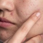 Winter Acne: చలికాలంలో మొటిమలా ? ఈ టిప్స్ పాటిస్తే.. క్షణాల్లోనే రిజల్ట్