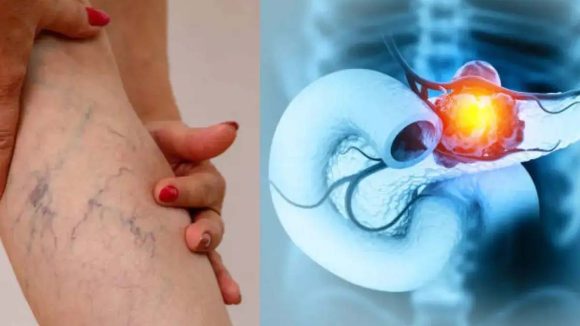 Pancreatic Cancer: మిలియన్ల మందిని బలితీసుకుంటున్న వ్యాధి.. కాళ్లలో కనిపించే ఈ లక్షణాలే మొదటి వార్నింగ్!