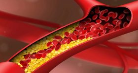 Blocked arteries: బ్లాక్ అయిన రక్తనాళాలను క్లియర్ చేసే 3 సహజ అలవాట్లు ఇవే.