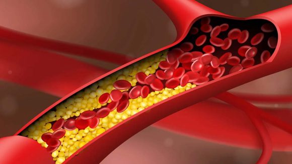 Blocked arteries: బ్లాక్ అయిన రక్తనాళాలను క్లియర్ చేసే 3 సహజ అలవాట్లు ఇవే.