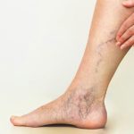 Venous Disease: రక్తనాళాల్లో రక్తం గడ్డకడితే .. ఇలాంటి లక్షణాలే కనిపిస్తాయ్