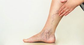 Venous Disease: రక్తనాళాల్లో రక్తం గడ్డకడితే .. ఇలాంటి లక్షణాలే కనిపిస్తాయ్