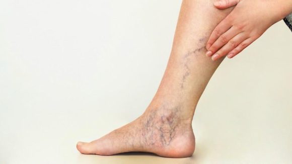 Venous Disease: రక్తనాళాల్లో రక్తం గడ్డకడితే .. ఇలాంటి లక్షణాలే కనిపిస్తాయ్