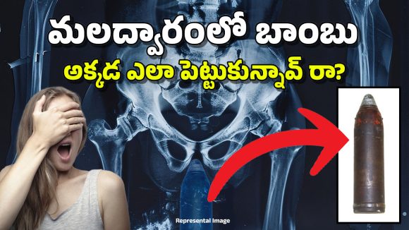 Bomb in Rectum: వీడెవడండి బాబు.. ఏకంగా బాంబునే ‘అక్కడ’ పెట్టుకున్నాడు, అది చూసి డాక్టర్లు.. పరుగులు