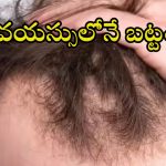 Bald Head: 30 ఏళ్లకే బట్టతలా ? మగవారు తప్పకుండా తెలుసుకోవాల్సిన నిజాలివే
