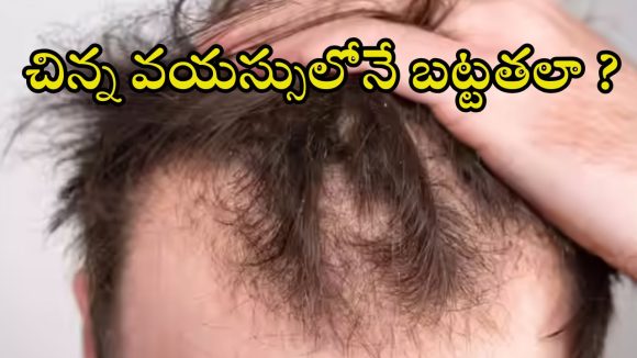 Bald Head: 30 ఏళ్లకే బట్టతలా ? మగవారు తప్పకుండా తెలుసుకోవాల్సిన నిజాలివే