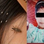 Head Lice Infestation: చిన్నారి ప్రాణం తీసిన పేలు.. అలా చేయడం వల్లే ఆమె చనిపోయిందా?