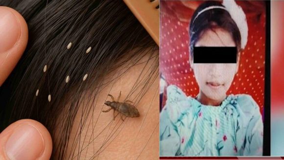Head Lice Infestation: చిన్నారి ప్రాణం తీసిన పేలు.. అలా చేయడం వల్లే ఆమె చనిపోయిందా?