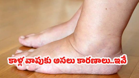 Foot Swelling Causes: కాళ్లలో వాపుకు కారణాలు.. తెలిస్తే షాక్ అవుతారు