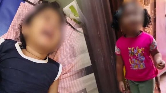 Vijayawada: విజయవాడలో దారుణం.. మూడేళ్ళ చిన్నారిపై టీచర్ యాసిడ్ దాడి