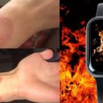 Apple Watch Burn: స్మార్ట్‌వాచ్‌తో చేతికి గాయాలు.. ఆపిల్ సపోర్ట్‌లో గందరగోళం