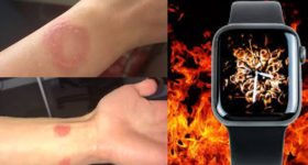 Apple Watch Burn: స్మార్ట్‌వాచ్‌తో చేతికి గాయాలు.. ఆపిల్ సపోర్ట్‌లో గందరగోళం