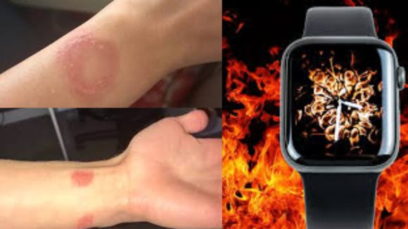 Apple Watch Burn: స్మార్ట్‌వాచ్‌తో చేతికి గాయాలు.. ఆపిల్ సపోర్ట్‌లో గందరగోళం