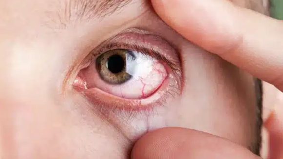Dry Eyes Deficiency: పొడిబారిన కళ్లు, తక్కువ రోగ నిరోధక శక్తితో బాధపడుతున్నారా? శరీరంలో ఆ విటమిన్ లోపమే కారణం