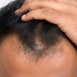 Hair Thinning Baldness: మీరు చేసే ఈ తప్పు వల్లే బట్టతల.. డాక్టర్లు చెప్పే జాగ్రత్తలు ఇవే
