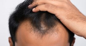 Hair Thinning Baldness: మీరు చేసే ఈ తప్పు వల్లే బట్టతల.. డాక్టర్లు చెప్పే జాగ్రత్తలు ఇవే