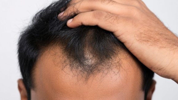 Hair Thinning Baldness: మీరు చేసే ఈ తప్పు వల్లే బట్టతల.. డాక్టర్లు చెప్పే జాగ్రత్తలు ఇవే