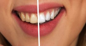 White teeth tips: దంతాలపై పసుపు గీతలు వచ్చాయా? ఈ సులభమైన చిట్కాలతో పళ్లు తెల్లగా మెరిసిపోతాయి