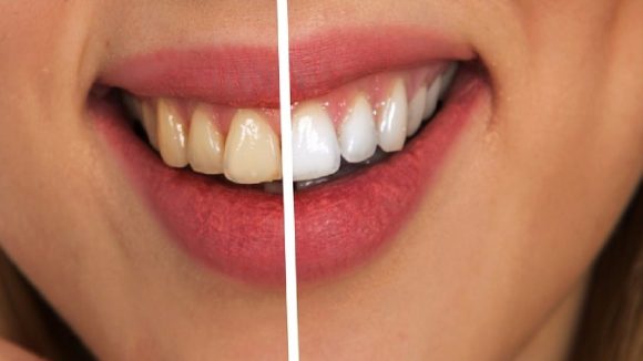 White teeth tips: దంతాలపై పసుపు గీతలు వచ్చాయా? ఈ సులభమైన చిట్కాలతో పళ్లు తెల్లగా మెరిసిపోతాయి
