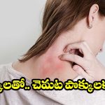చెమట కాయలను నిమిషాల్లో తగ్గించే.. పవర్ ఫుల్ చిట్కాలు!