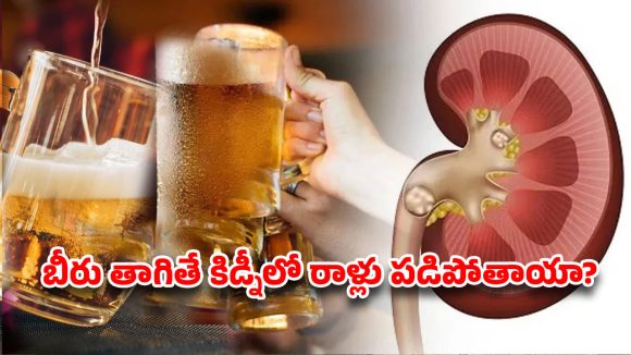 కిడ్నీలో రాళ్లా? బీరు తాగితే కరిగిపోతాయా?