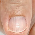 Nails Health:  గోళ్లపై గీతలు కనిపిస్తున్నాయా? అయితే మీ ఆరోగ్యం జాగ్రత్త