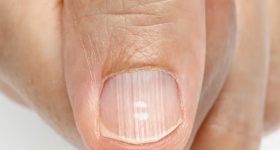Nails Health:  గోళ్లపై గీతలు కనిపిస్తున్నాయా? అయితే మీ ఆరోగ్యం జాగ్రత్త