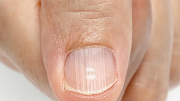 Nails Health:  గోళ్లపై గీతలు కనిపిస్తున్నాయా? అయితే మీ ఆరోగ్యం జాగ్రత్త