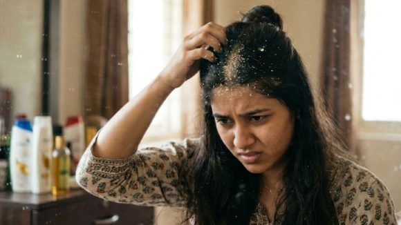 చుండ్రు కారణంగా ఎప్పుడూ తలలో దురదగా ఉందా? ఇంట్లో తయారు చేసే హెయిర్ మాస్క్ ట్రై చేశారా?