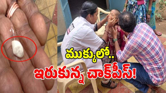 Chalk Piece: చిన్నారి ముక్కులో ఇరుక్కున్న చాక్‌పీస్.. చివరికి..