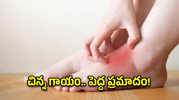 సెల్యూలైటిస్ అంటే ఏంటి? దీని లక్షణాలు, చికిత్స వివరాలు ఇవే!